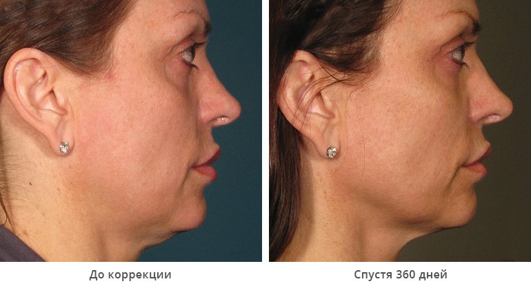 Безоперационный лифтинг лица. Результаты до и после