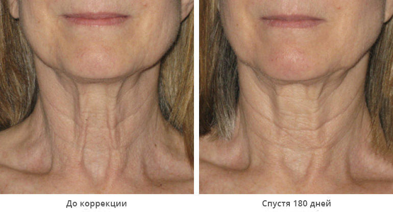 ultherapy-0028-0086w_180day_1tx_neck_gallery