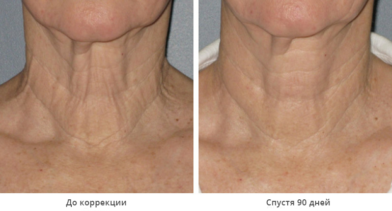 ultherapy-bl0017_90day_1tx_neck_gallery