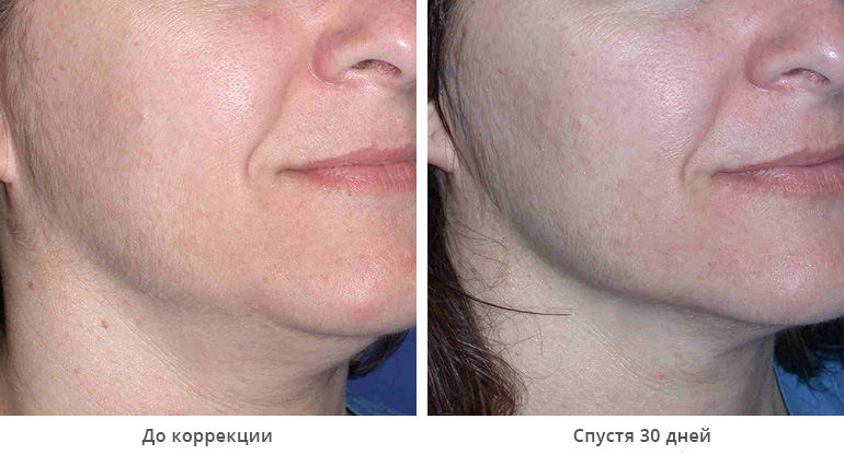 before_after_ultherapy_results_under-chin31