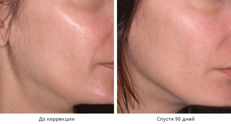 before_after_ultherapy_results_under-chin32
