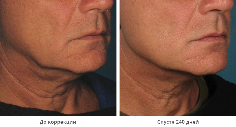 before_after_ultherapy_results_under-chin35