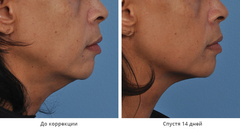 before_after_ultherapy_results_under-chin37