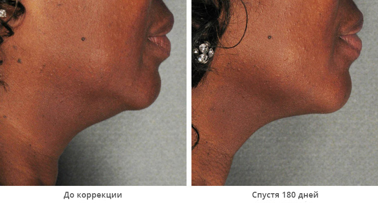 chin-gallery-2