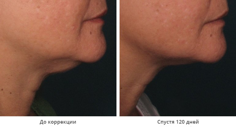 before_after_ultherapy_results_under-chin1