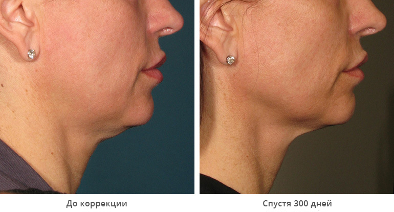 before_after_ultherapy_results_under-chin4