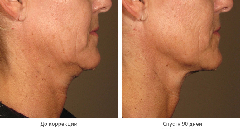 before_after_ultherapy_results_under-chin8
