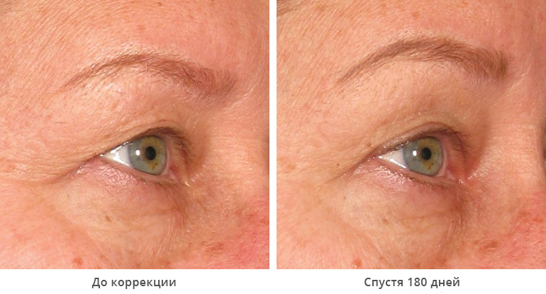 img_template_beforeafter_brow7
