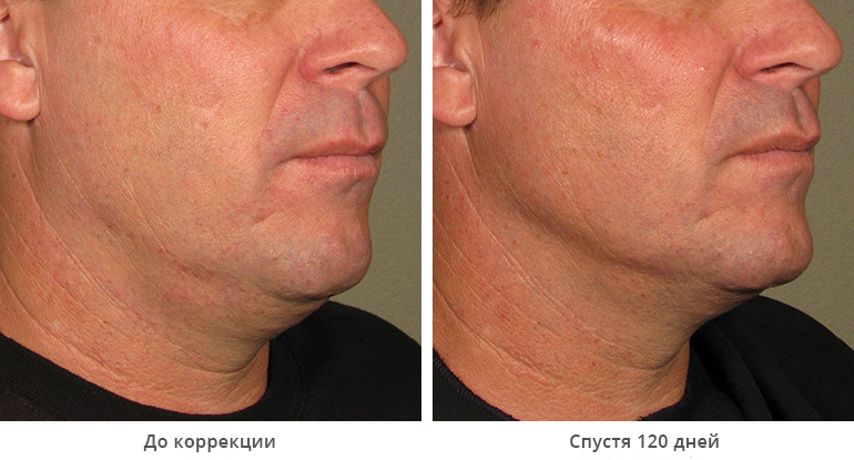 before_after_ultherapy_results_under-chin12