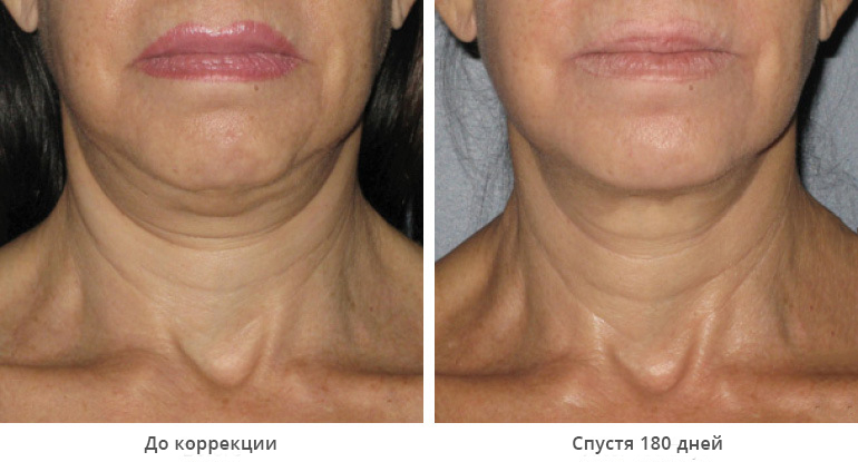 ultherapy-0008-0086w_180day_1tx_neck1_gallery