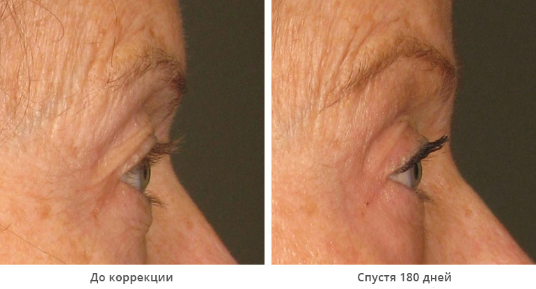 img_template_beforeafter_brow9