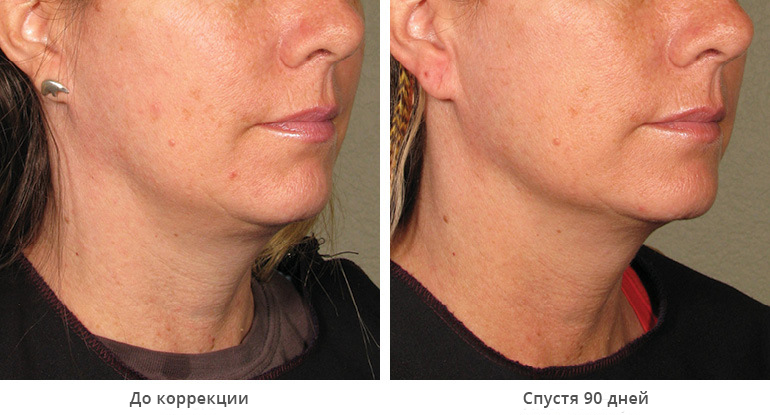 before_after_ultherapy_results_under-chin11