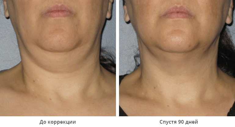 ultherapy-0014-0086w_90day_1tx_neck_gallery