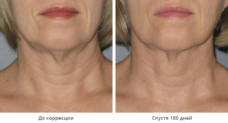 ultherapy-0025-0086w_180day_1tx_neck_gallery